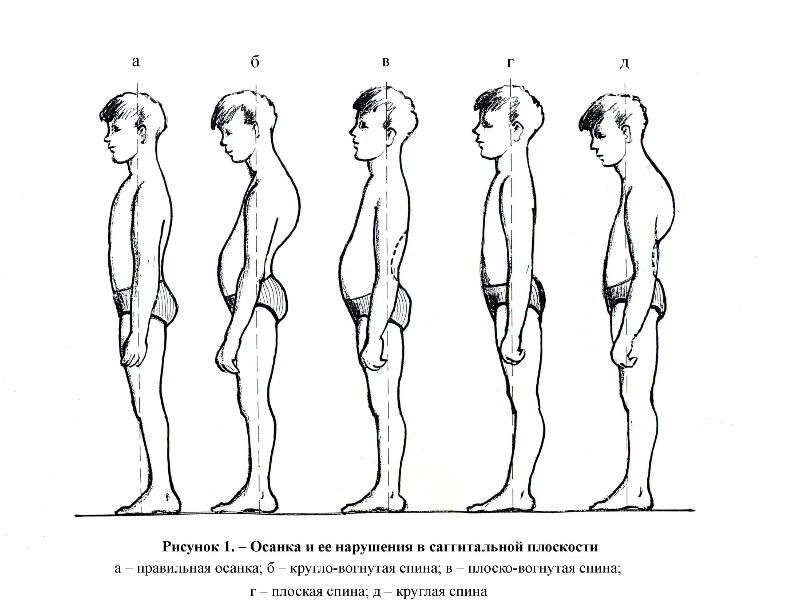 Как называется нарушение осанки изображенное на рисунке 3