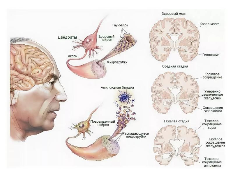 Картинки на болезнь альцгеймера