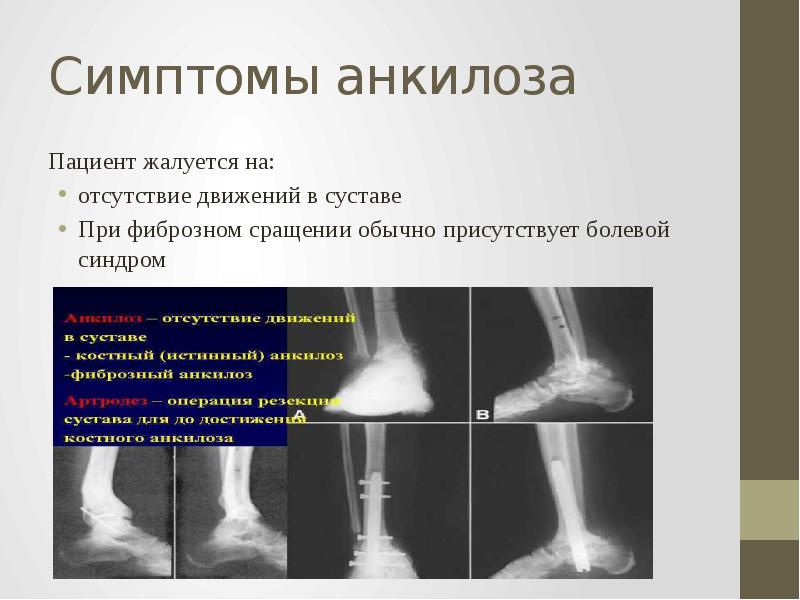 Анкилоз сустава