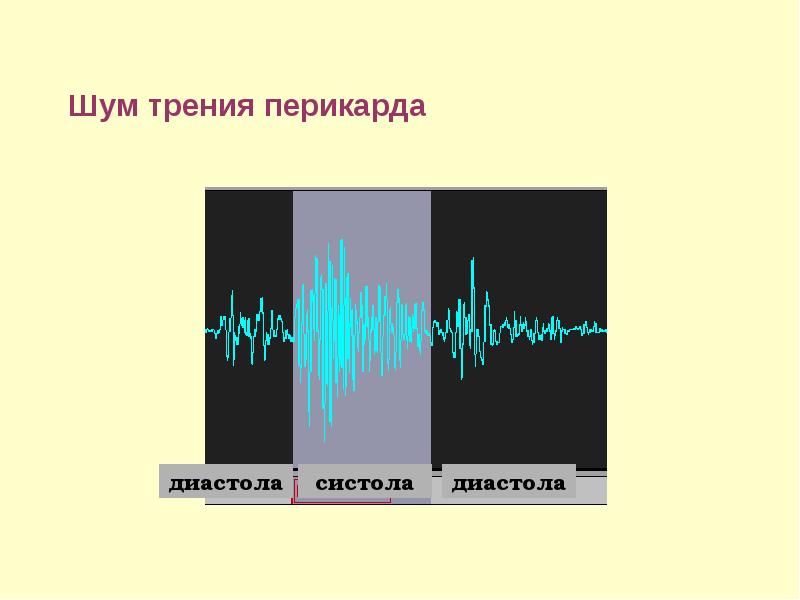 Эндокардит миокардит перикардит презентация