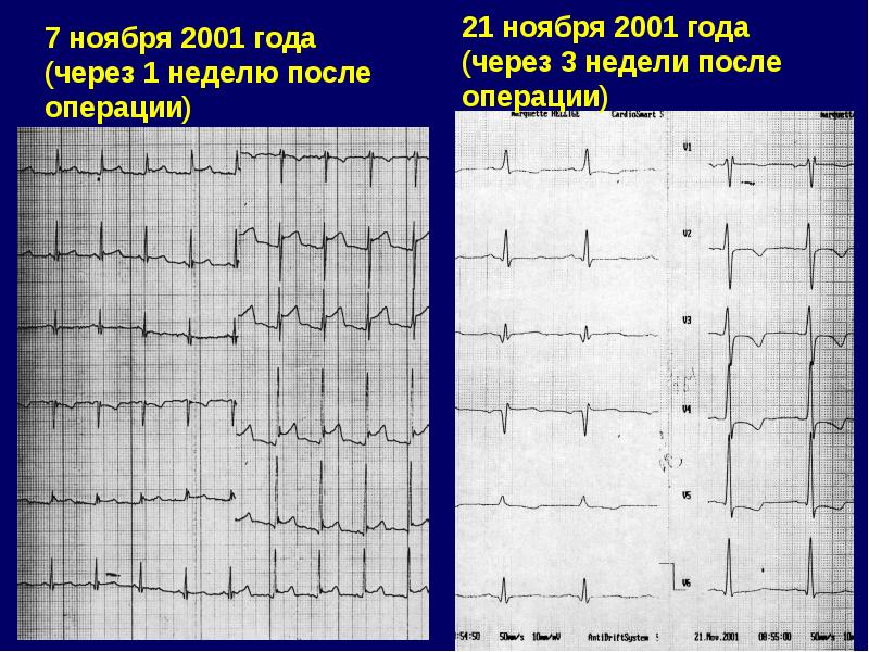 Операции в ноябре. Типичным изменением на ЭКГ при остром перикардите является. PQ при перикардите. ЭКГ при перикардите презентация. Перикардиты презентация хирургия.