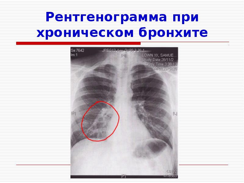 Пневмония презентация казакша