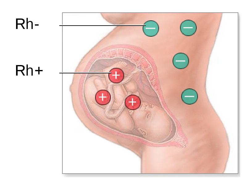 Изосерологическая несовместимость крови матери и плода презентация