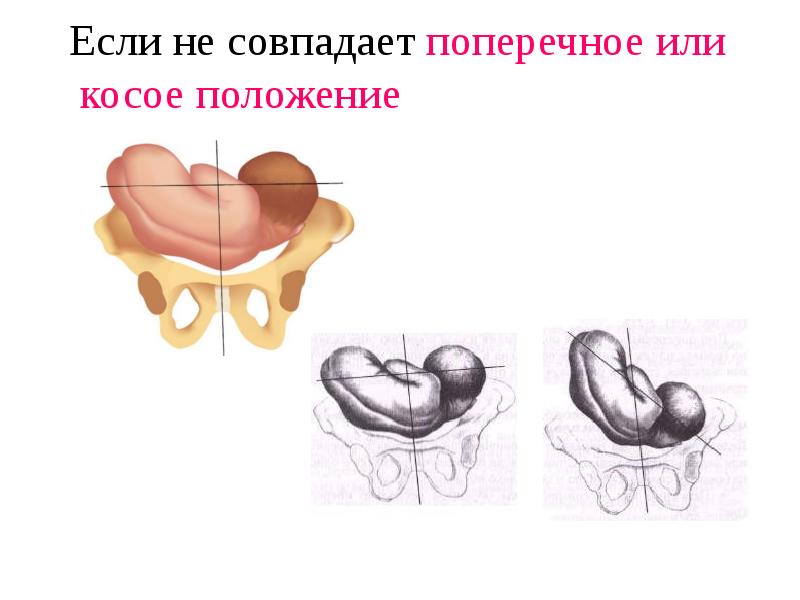 Отношение спинки плода к стенкам матки