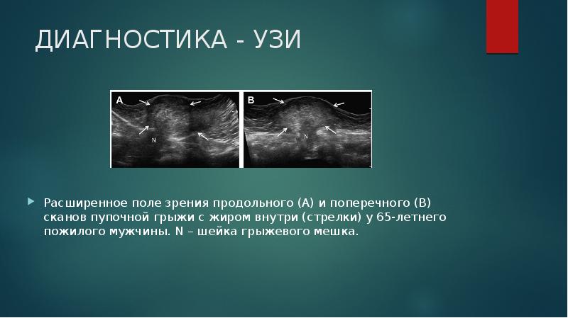 Грыжи передней брюшной стенки у детей презентация