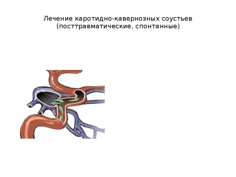 Каротидно феморальная спв