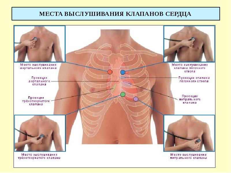 МЕСТА ВЫСЛУШИВАНИЯ КЛАПАНОВ СЕРДЦА