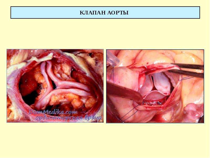КЛАПАН АОРТЫ