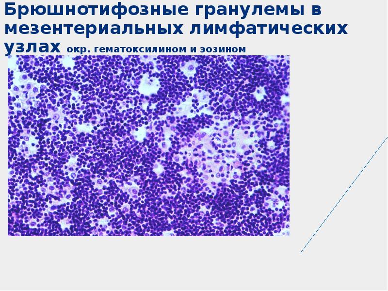 Презентация брюшной тиф патанатомия