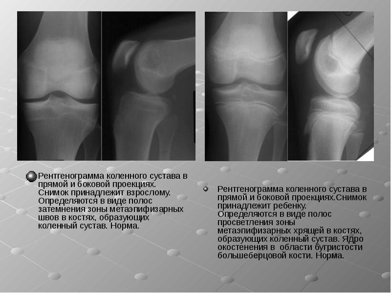 Рентген коленного сустава фото в норме и нет