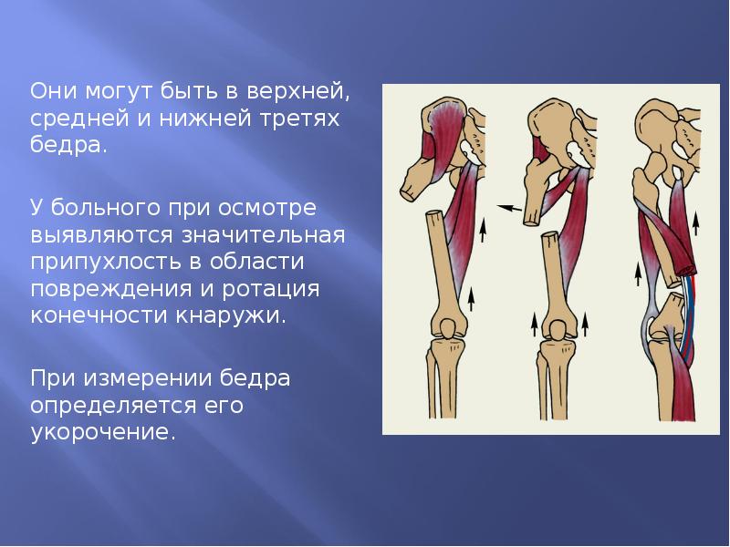 Перелом бедренной кости презентация