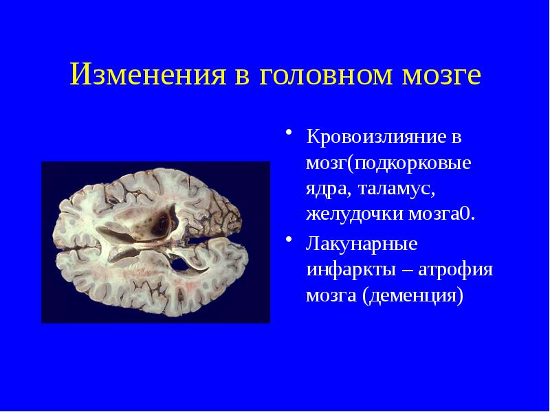 Атрофия головного мозга продолжительность. Желудочки головного мозга макропрепарат. Лакунарные изменения головного мозга. Кровоизлияния кровоизлияния в мозг.