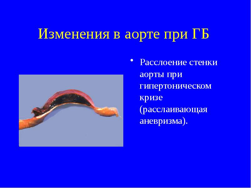 Склероз аорты сердца что. Атеросклеротические изменения стенок аорты. Склеротические изменения аорты что это.