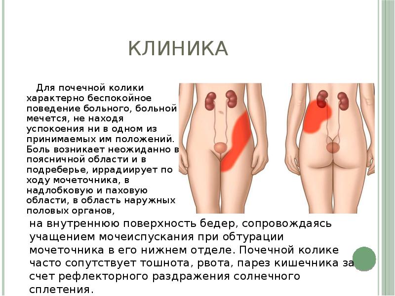 Что может болеть в паху у мужчин. При почечной колике боль иррадиирует. Локализация боли при почечной колике. Почечная колика положение больного. Боли по типу почечной колики характерны для.