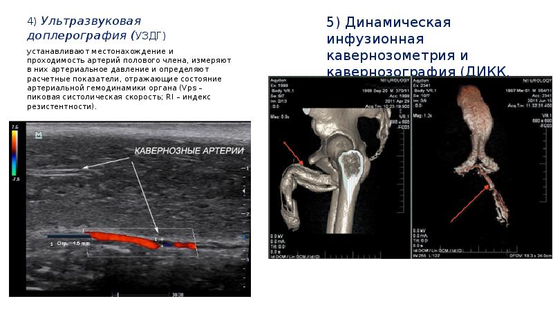 Эректильная дисфункция презентация урология