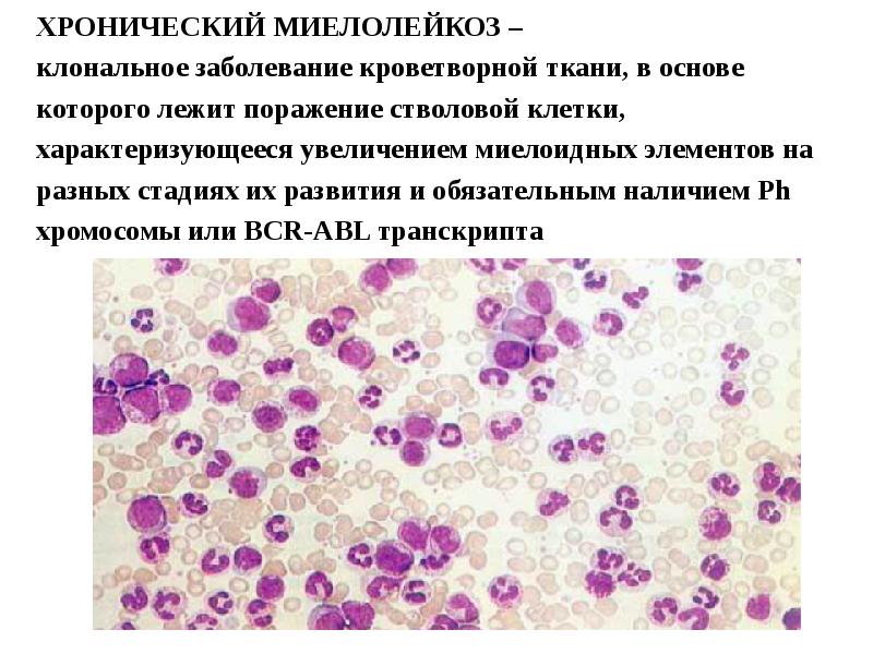 Картина крови и костного мозга при хроническом миелолейкозе истинной полицитемии