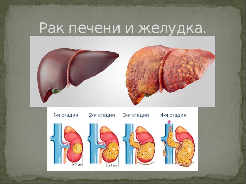 Рак печени и желудка. Рак печени и желудка.