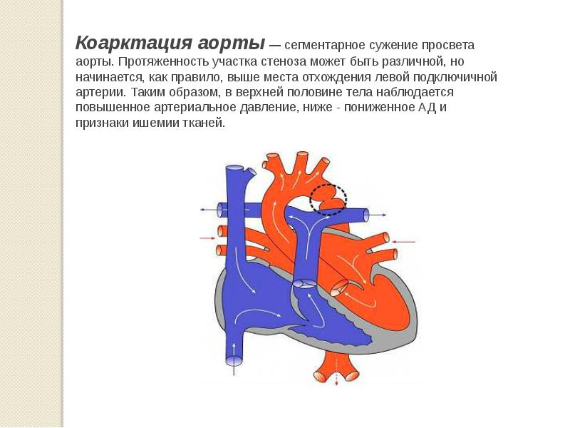 Коарктация аорты у детей презентация