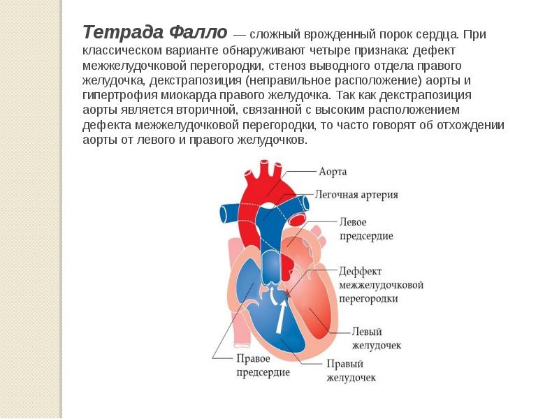 Порок тетрада фалло