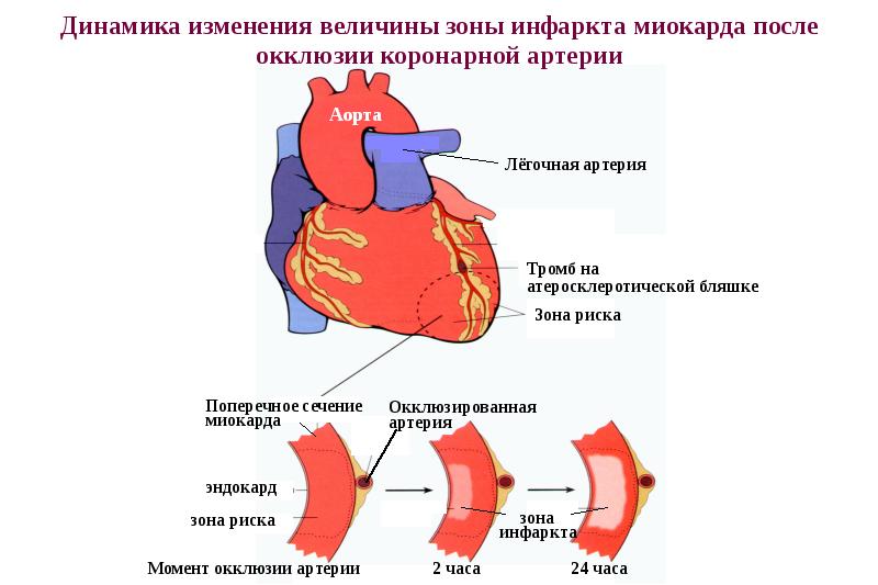 Коронарная недостаточность презентация