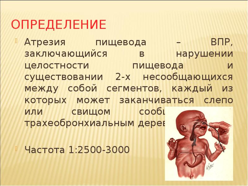 Низкая атрезия. Атрезия пищевода эмбриогенез. Атрезия пищевода у новорожденных. Атрезия пищевода с трахеобронхиальным свищом. Атрезия Хоан у новорожденного.