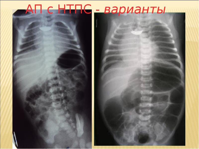 Атрезия пищевода. Атрезия пищевода (безсвищевая форма) рентген. Атрезия пищевода у детей рентген. Атрезия пищевода рентген.