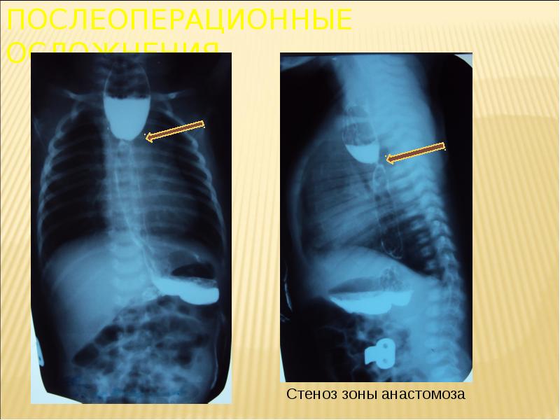 Атрезия пищевода. Атрезия пищевода послеоперационные осложнения. Атрезия пищевода осложнения. Атрезия пищевода осложнения после операции. Послеоперационной осложнённое атрезии пищевода.