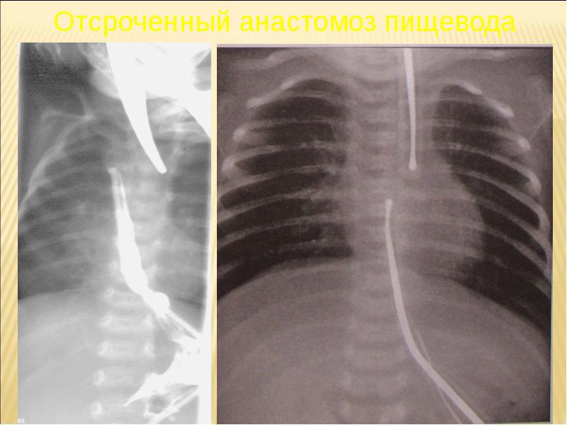 Атрезия пищевода у детей презентация