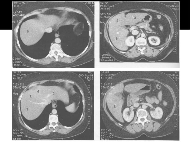 Сегменты печени по кт схема