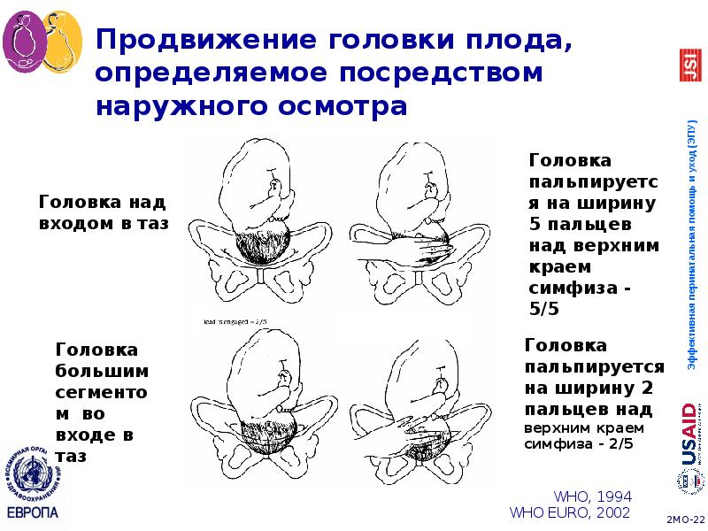 Продвижение головки плода, определяемое посредством наружного осмотра Продвижение головки плода, определяемое посредством наружного осмотра