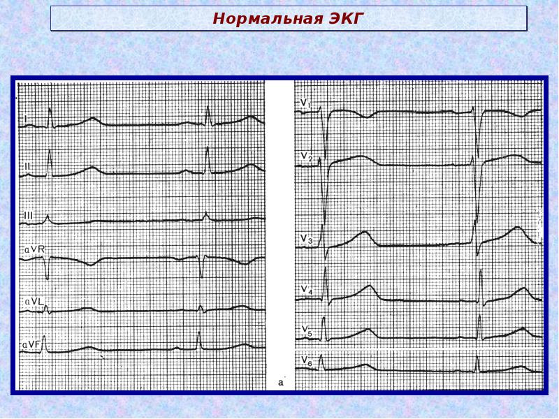 Рисунок нормальной кардиограммы сердца