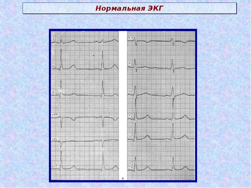 Рисунок нормальной кардиограммы