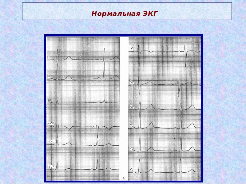 Рисунок нормальной кардиограммы