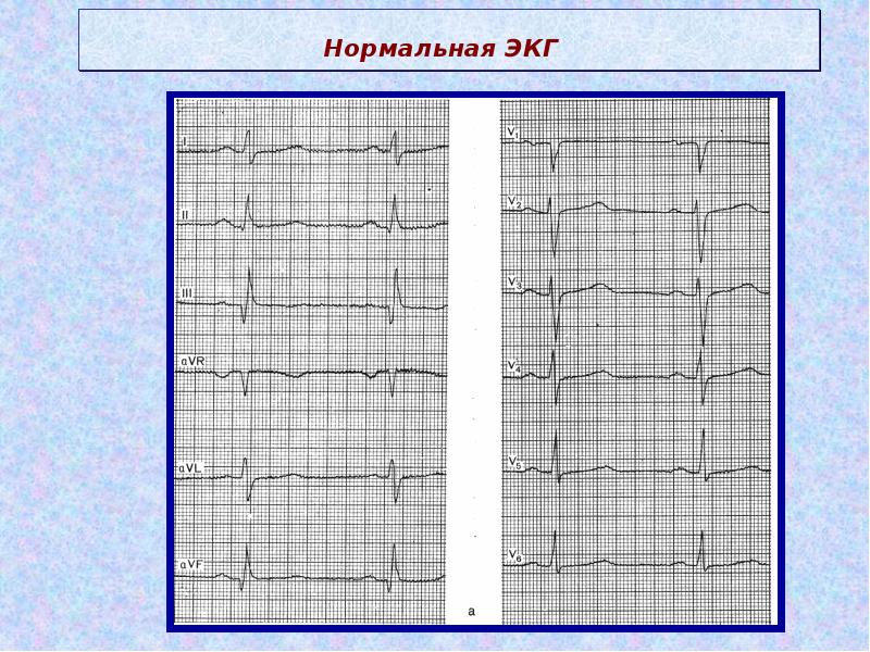 Рисунок нормальной кардиограммы