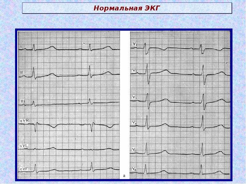 Схема нормальной экг