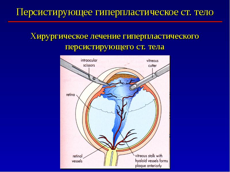 Отслоение задней стенки стекловидного тела глаза лечение