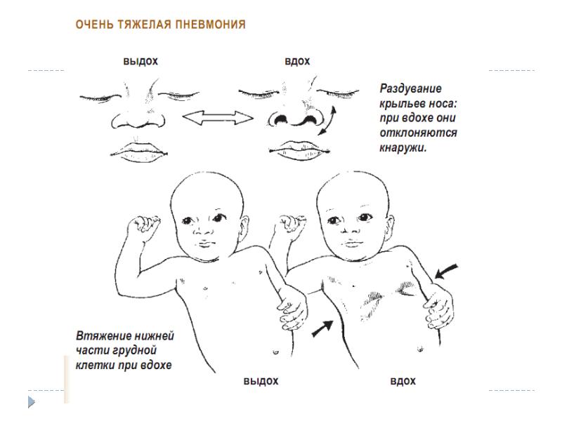 Пневмония у новорожденных презентация - 98 фото
