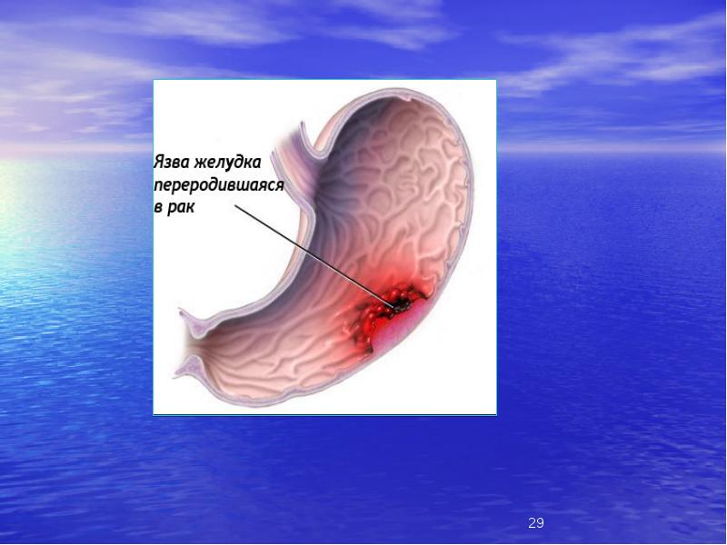 Язва желудка картинки для детей