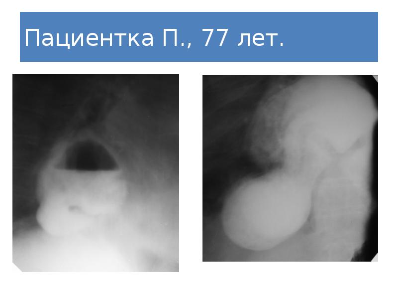 Презентация грыжи диафрагмы