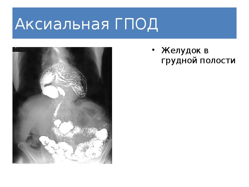 Грыжа диафрагмы картинки