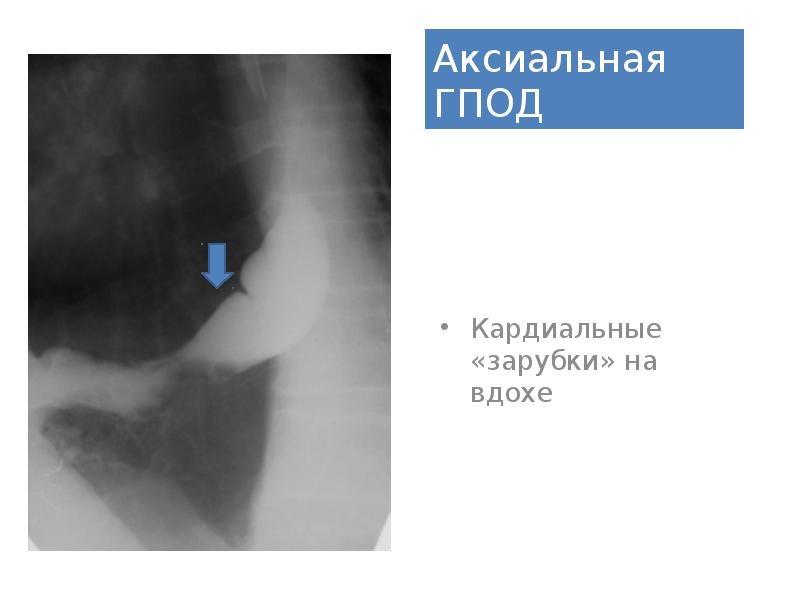 Эндоскопическая картина гпод