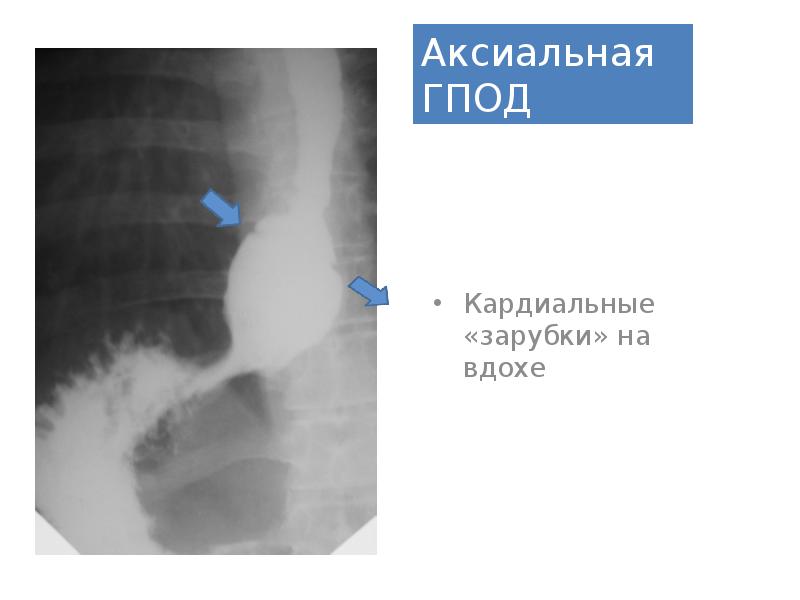 Эндоскопическая картина гпод