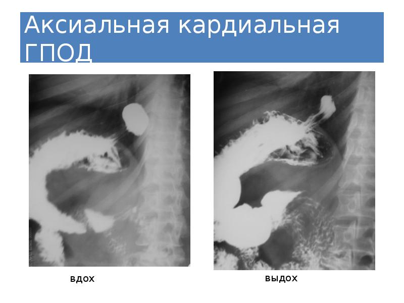 Эндоскопическая картина гпод