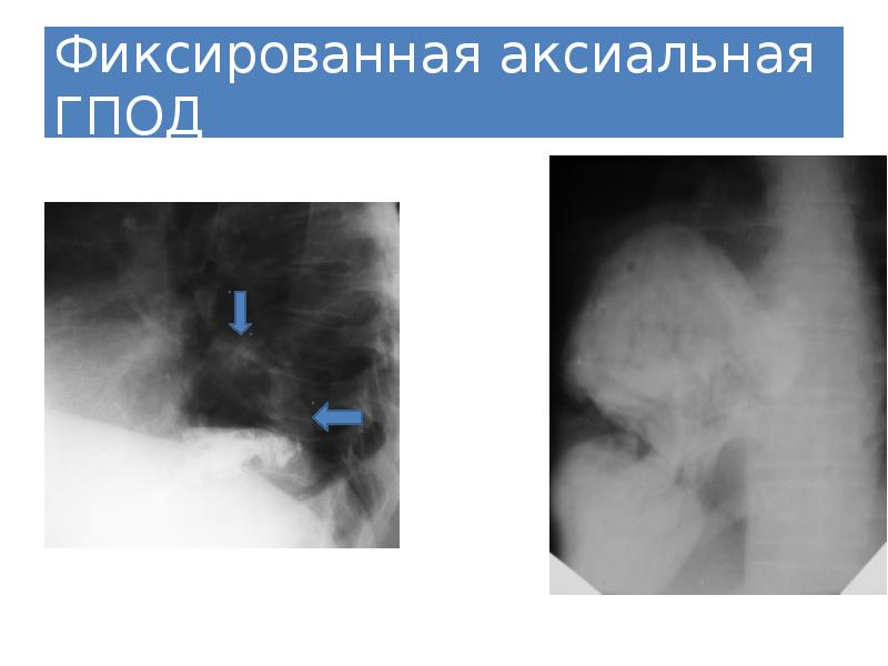 Эндоскопическая картина при грыжах пищеводного отверстия диафрагмы характеризуется