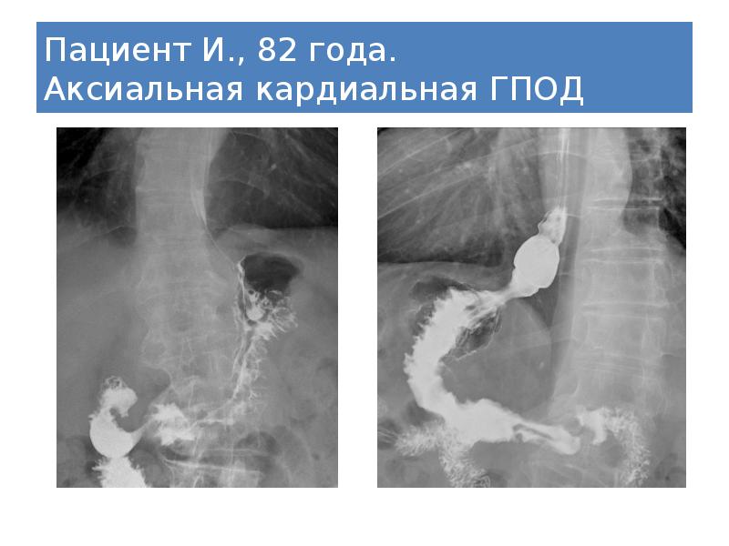 Эндоскопическая картина гпод