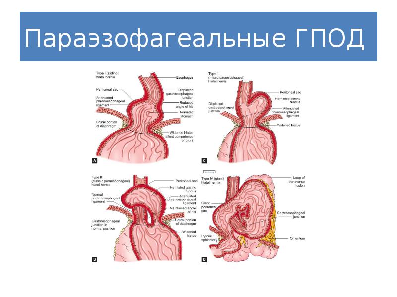 Грыжи пищеводного отверстия диафрагмы презентация по хирургии