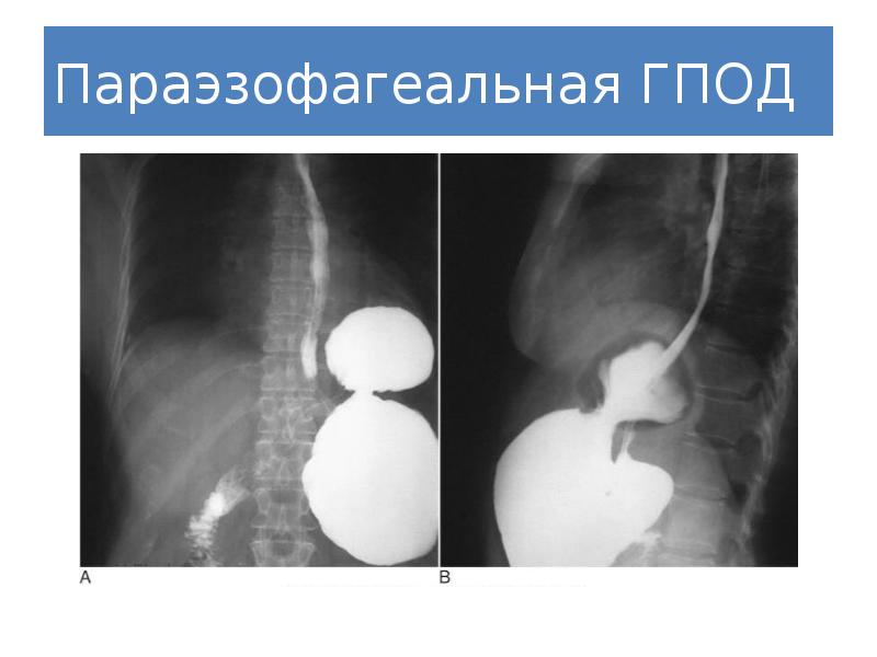 Эндоскопическая картина гпод