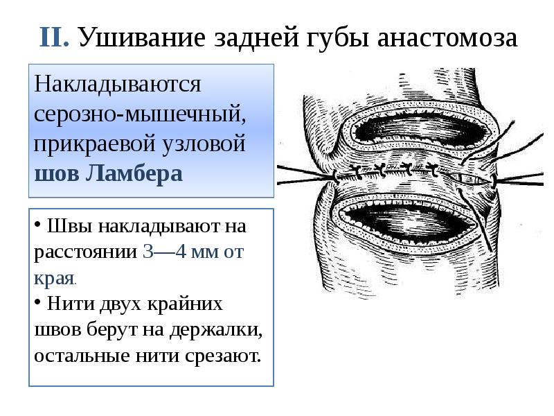 II. Ушивание задней губы анастомоза Накладываются серозно-мышечный, прикраевой узловой шов Ламбера