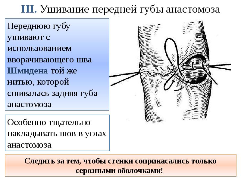 III. Ушивание передней губы анастомоза