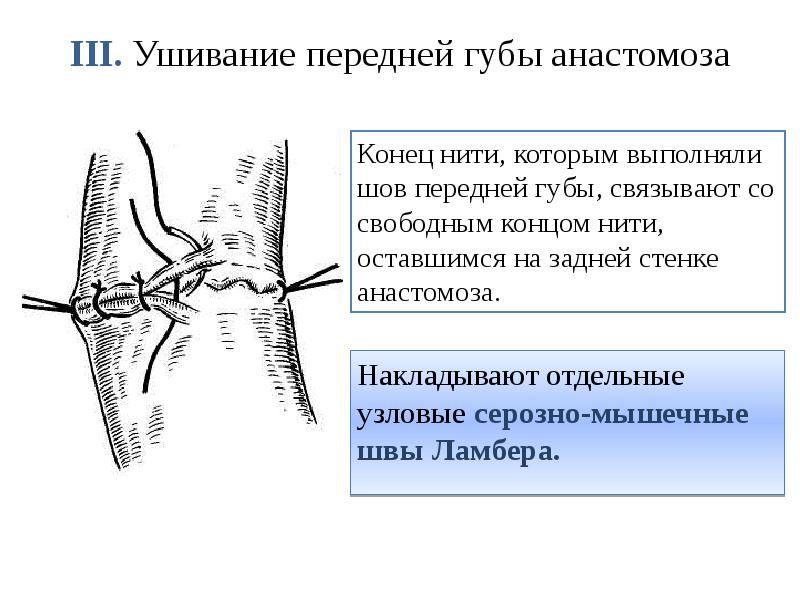 III. Ушивание передней губы анастомоза